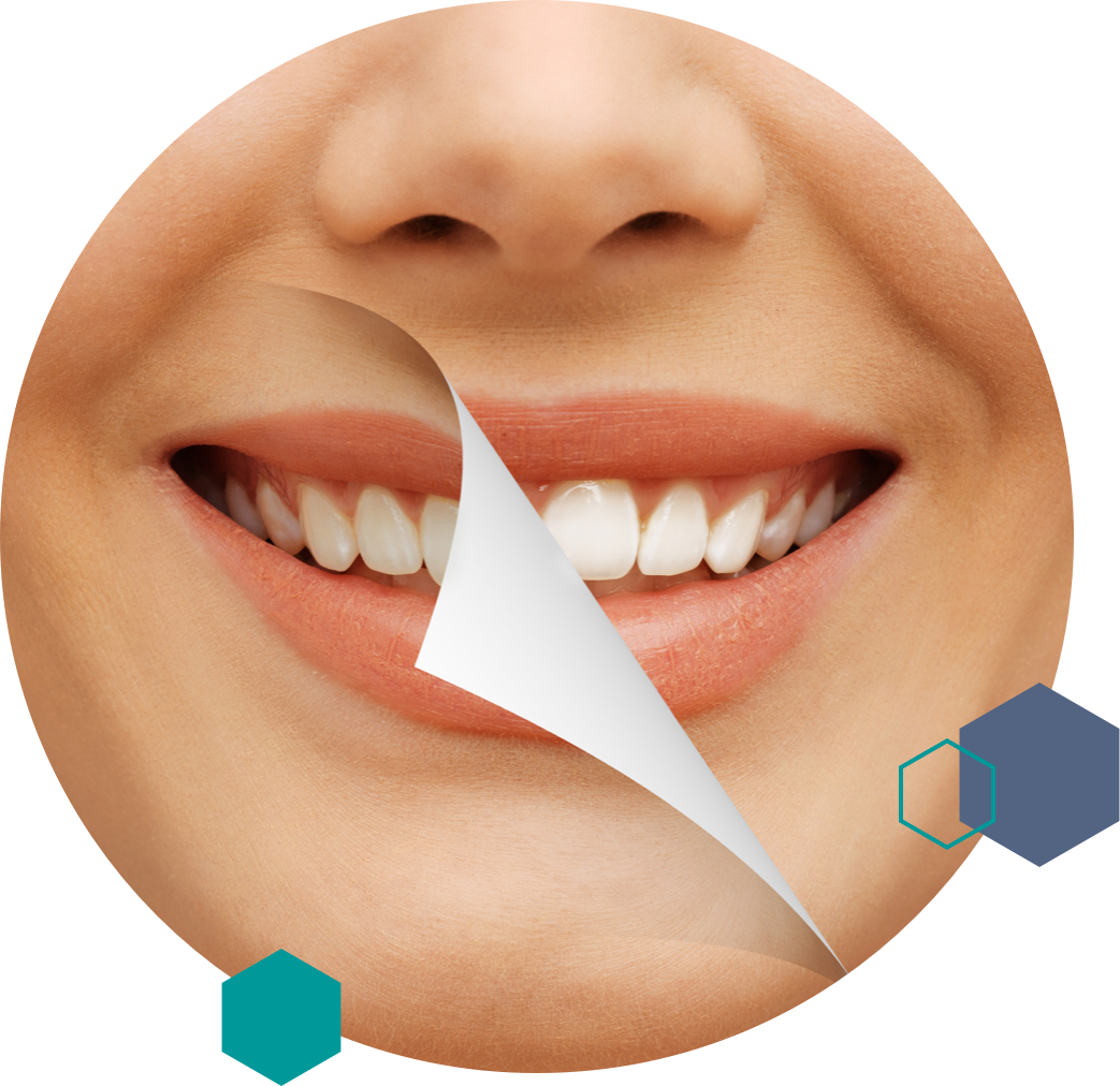 image <strong>Sbiancamento dentale</strong> <br>Denti più bianchi ed estetica del sorriso con il tuo dentista